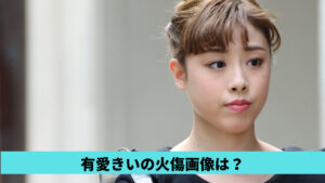 有愛きいの火傷画像はあるの？おでこにないのはなぜ？理由3つ！いじめは嘘？